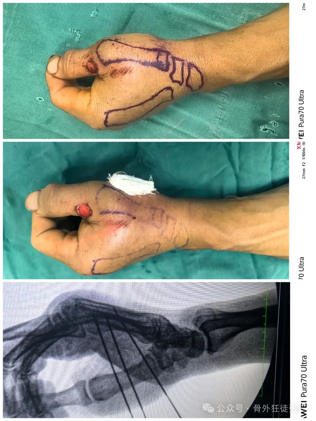 克氏针支架在Winterstein-Bennett-Rolando-反Bennett骨折中的应用