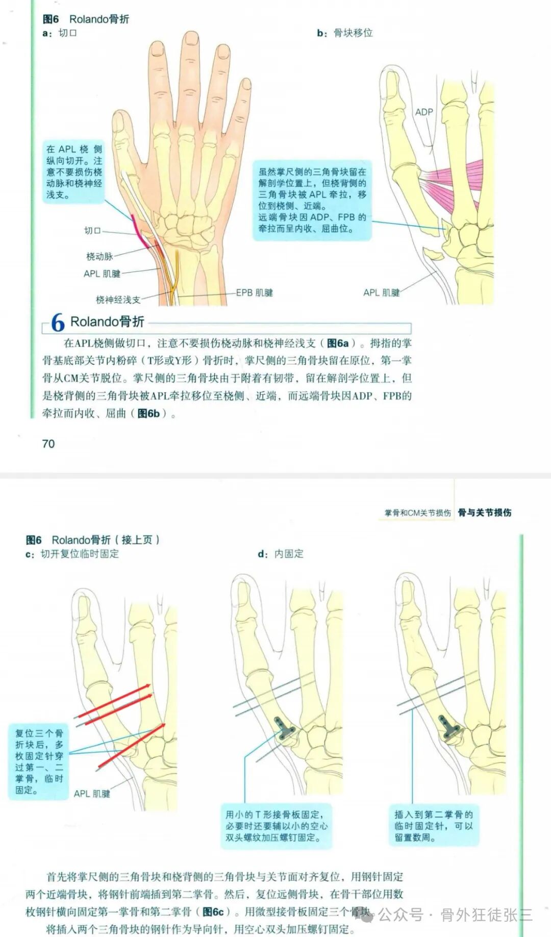 克氏针支架在Winterstein-Bennett-Rolando-反Bennett骨折中的应用
