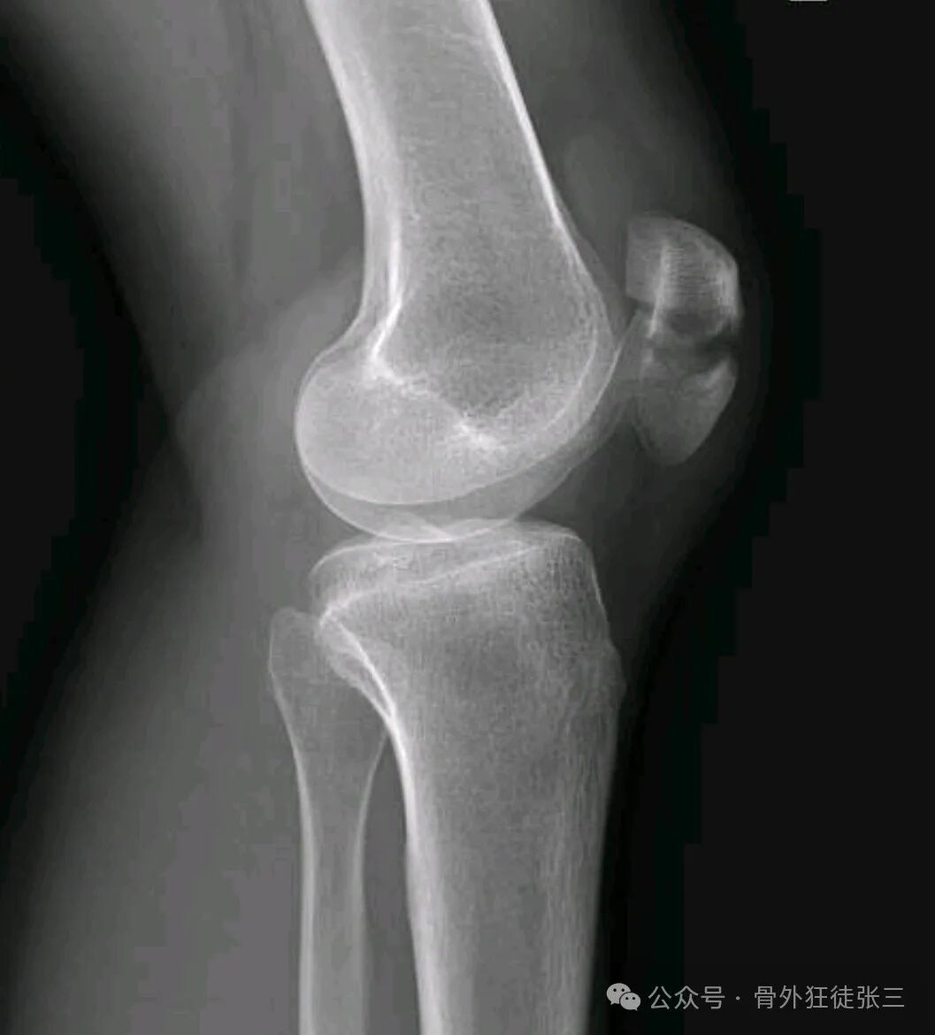 髌骨骨折，微创经皮空心钉的治疗