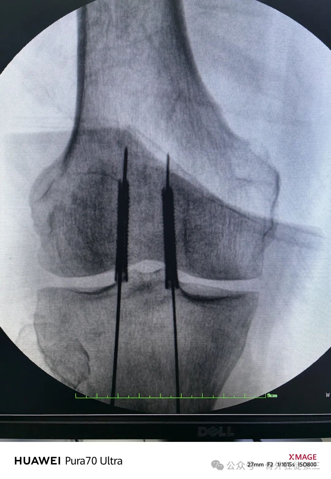 髌骨骨折，微创经皮空心钉的治疗
