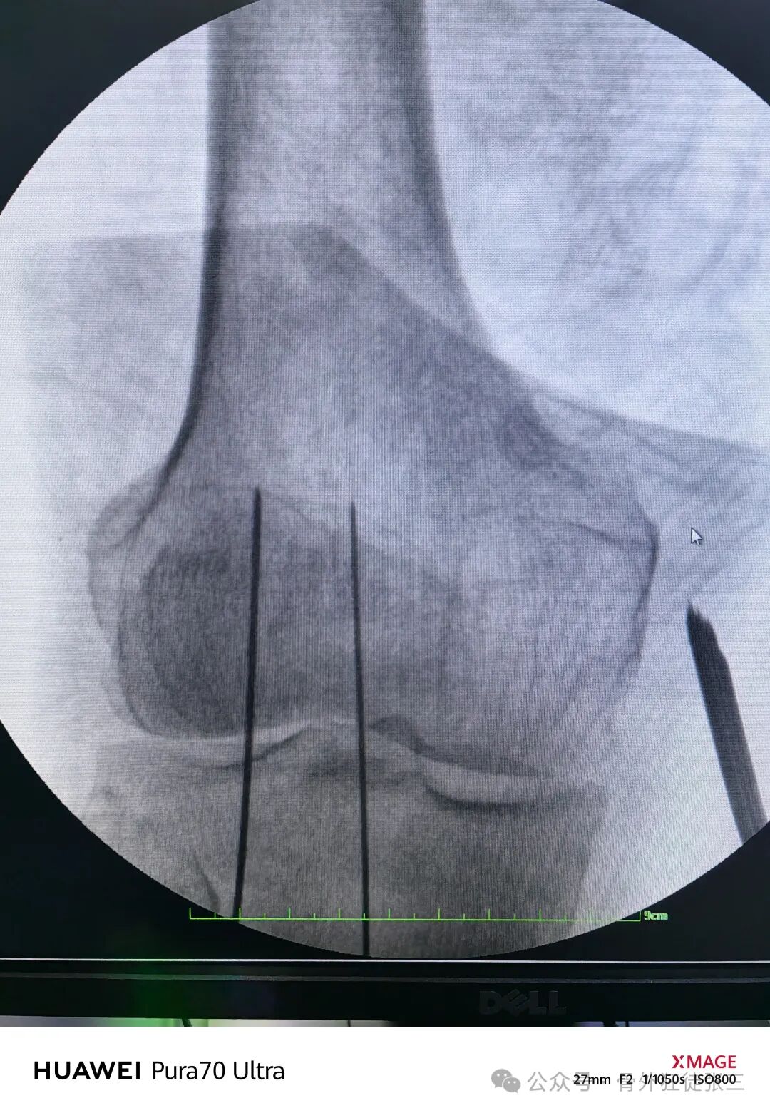 髌骨骨折，微创经皮空心钉的治疗