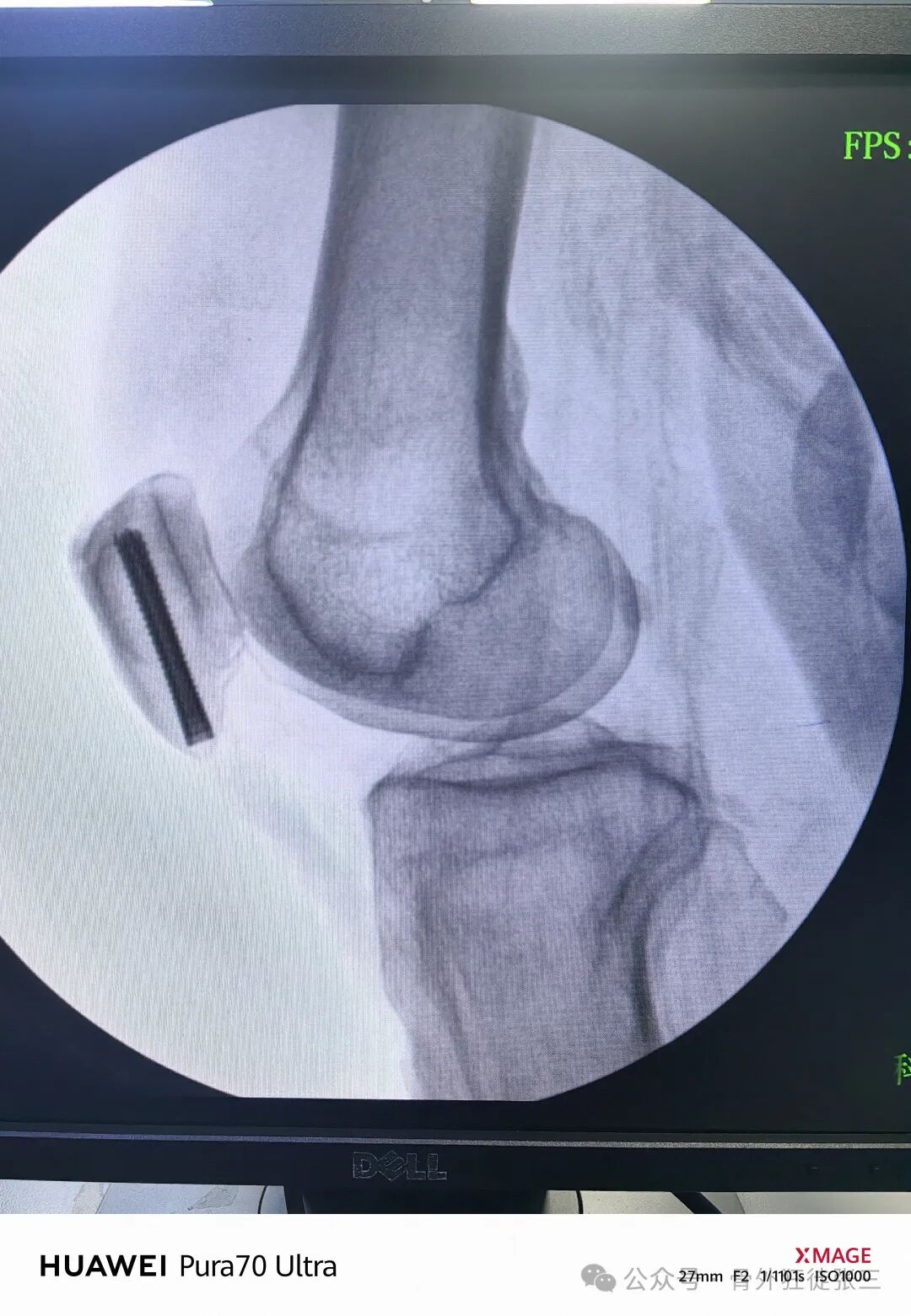 髌骨骨折，微创经皮空心钉的治疗
