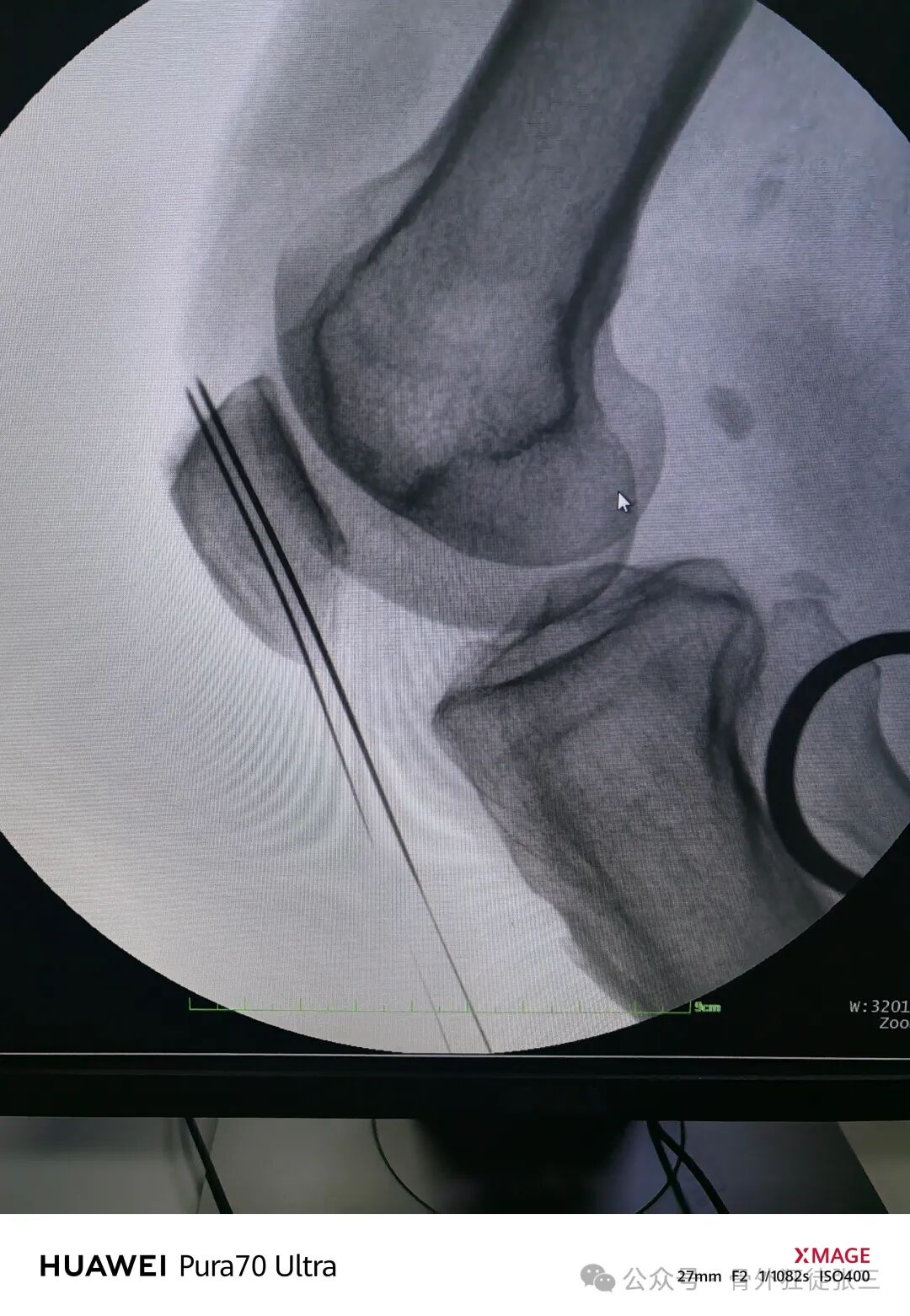 髌骨骨折，微创经皮空心钉的治疗