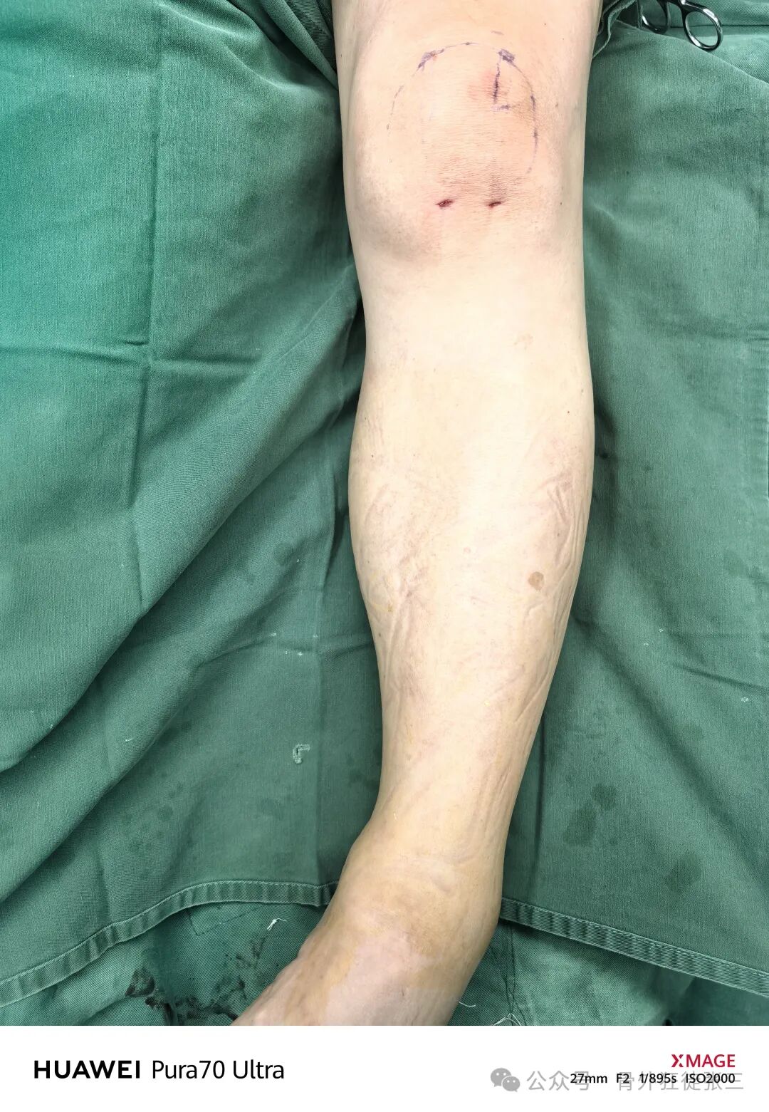 髌骨骨折，微创经皮空心钉的治疗