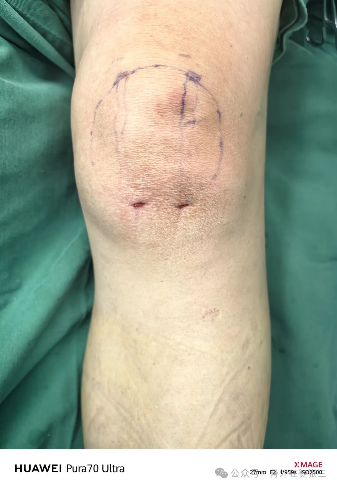 髌骨骨折，微创经皮空心钉的治疗