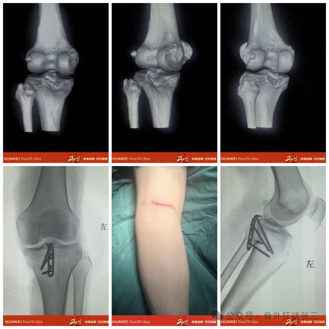 后交叉韧带胫骨止点撕脱骨折