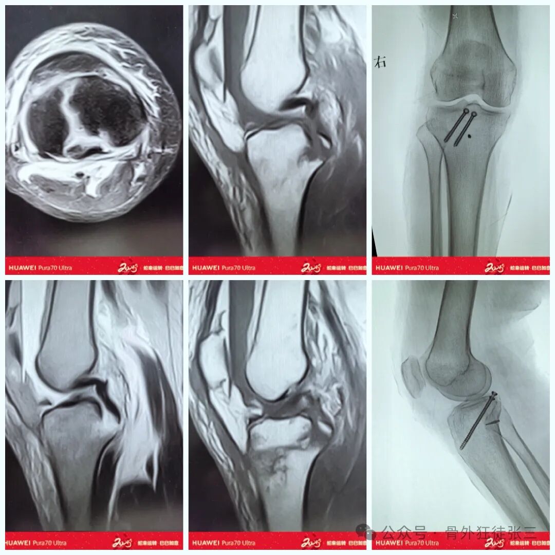 后交叉韧带胫骨止点撕脱骨折