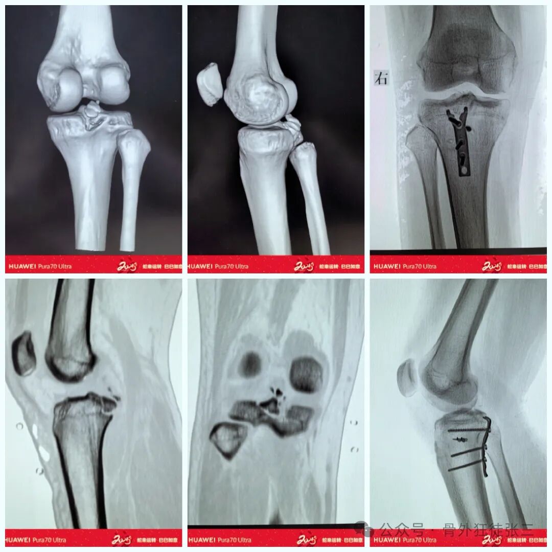 后交叉韧带胫骨止点撕脱骨折