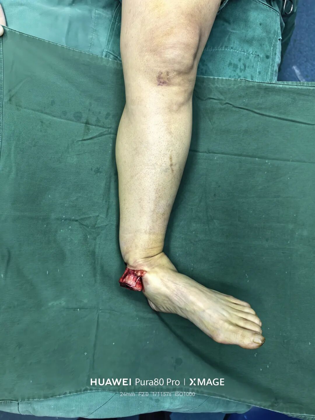 怎么做开放踝关节骨折脱位，高清图解！