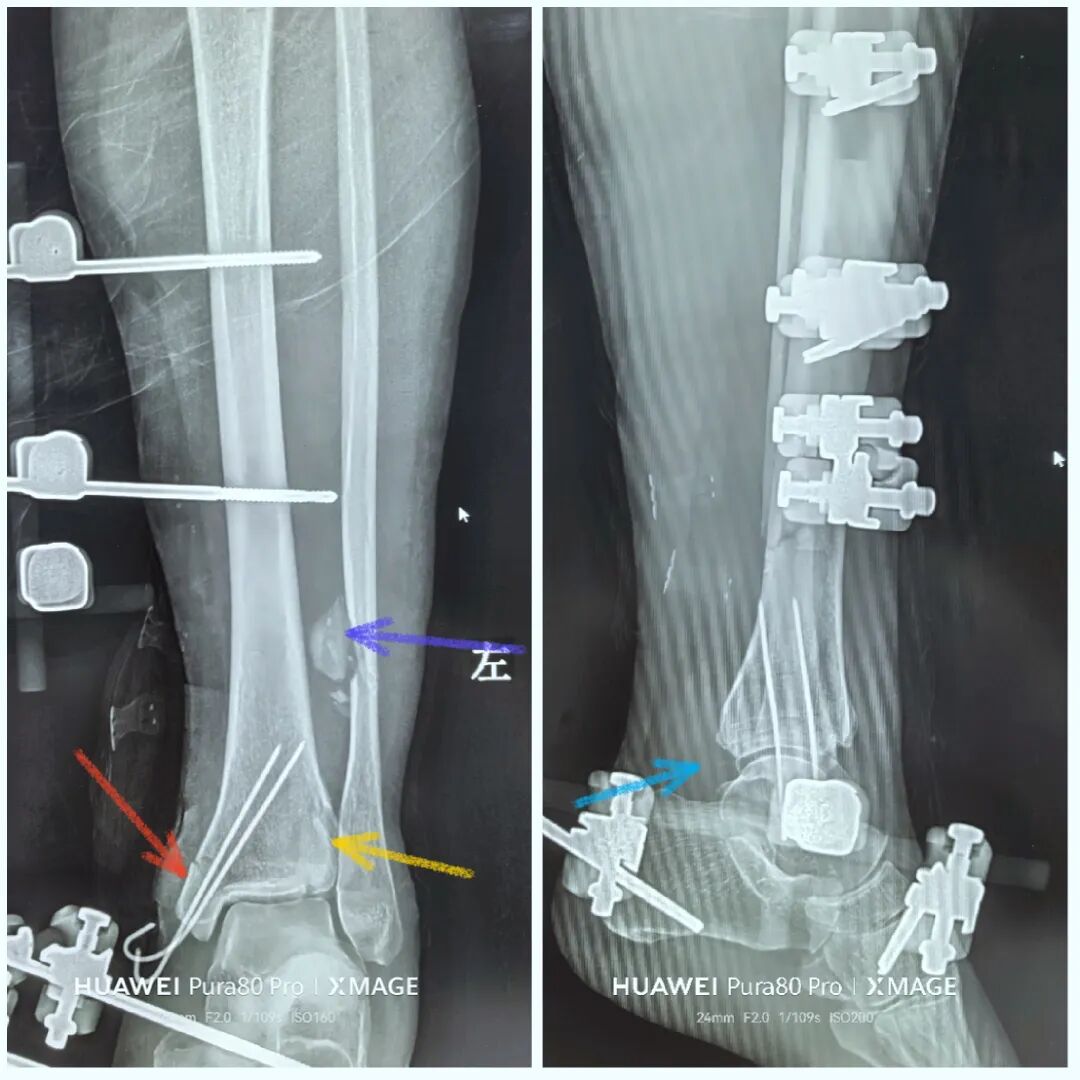 怎么做开放踝关节骨折脱位，高清图解！