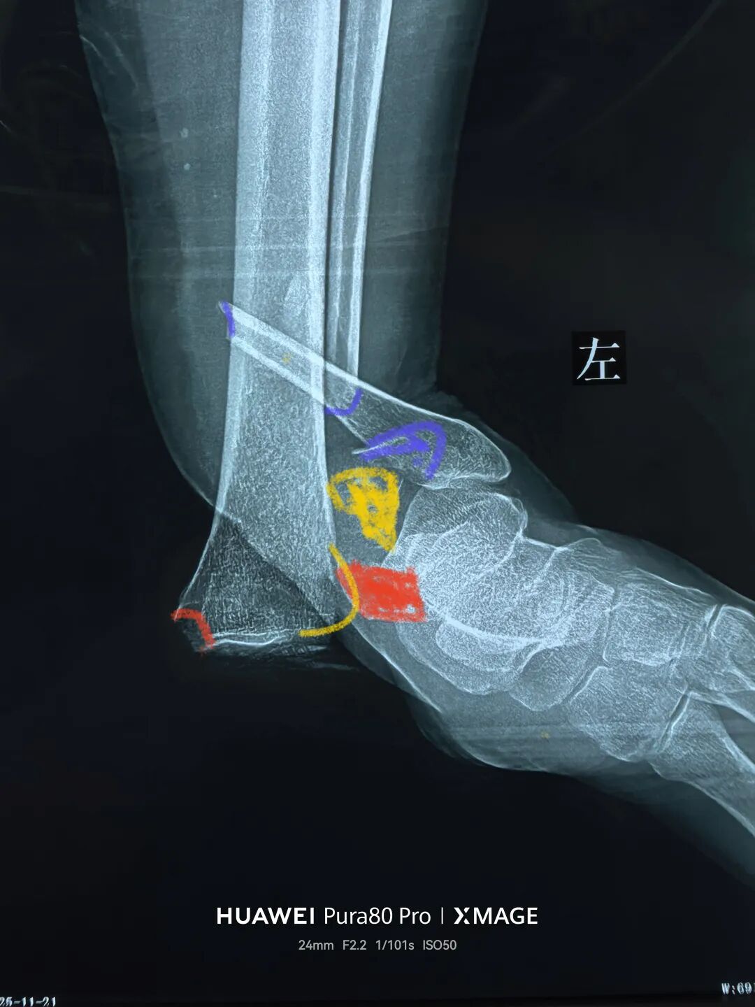 怎么做开放踝关节骨折脱位，高清图解！