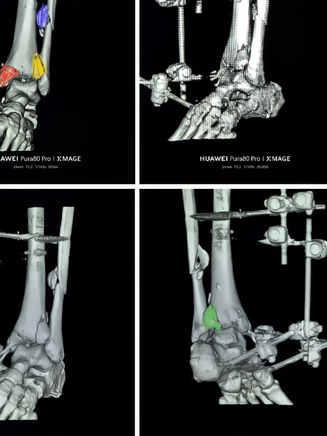 怎么做开放踝关节骨折脱位，高清图解！