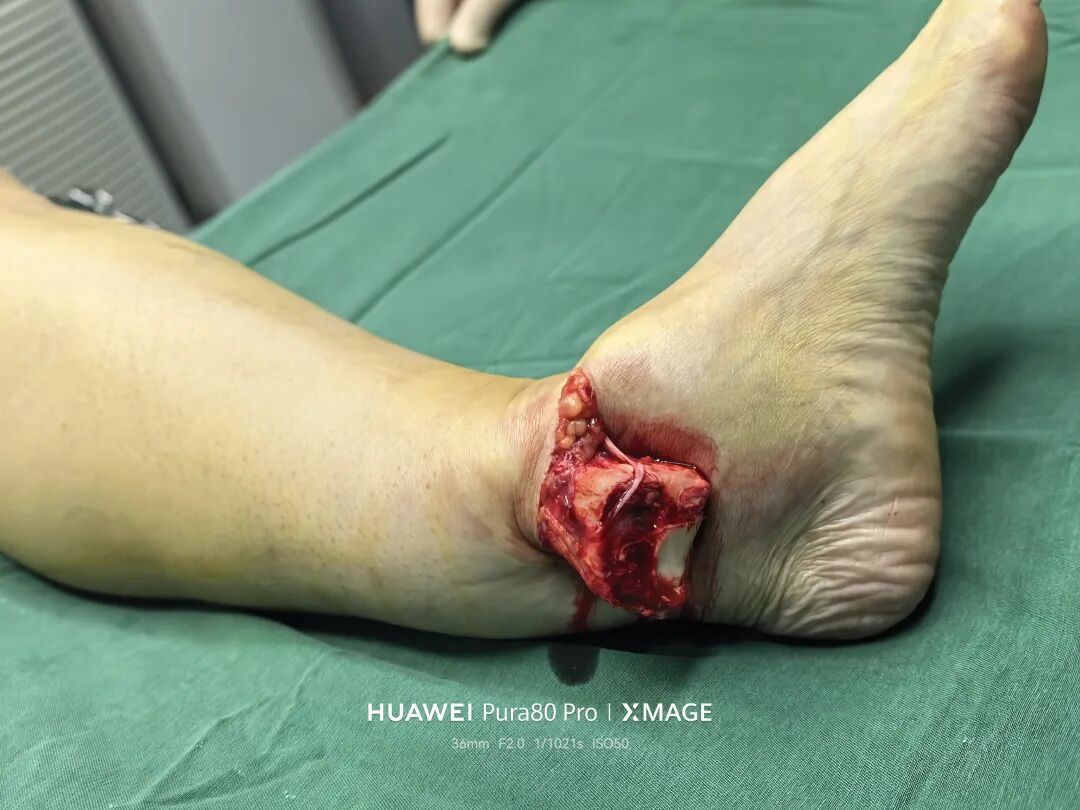 怎么做开放踝关节骨折脱位，高清图解！