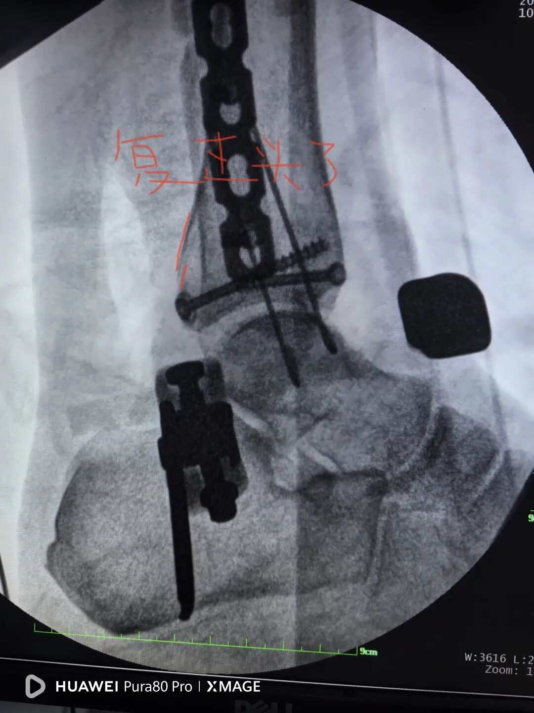 怎么做开放踝关节骨折脱位，高清图解！