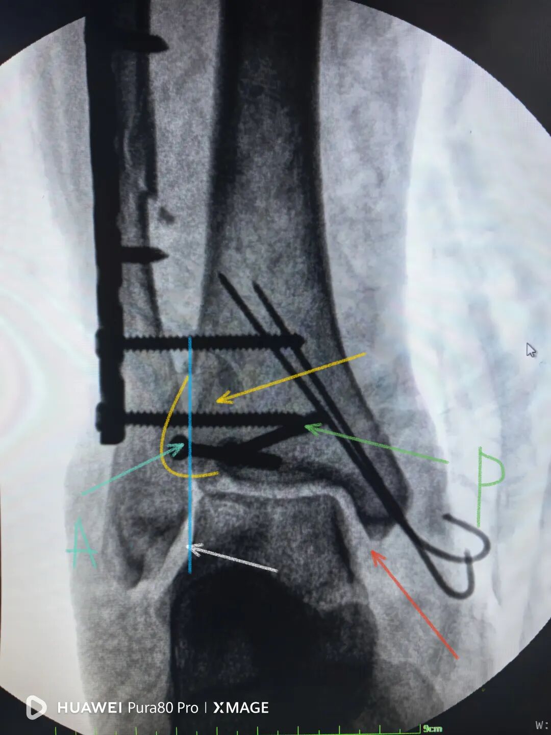 怎么做开放踝关节骨折脱位，高清图解！