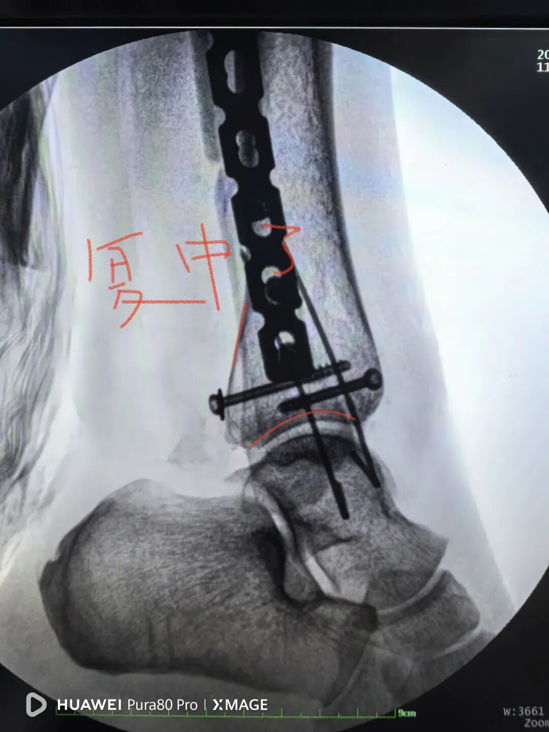 怎么做开放踝关节骨折脱位，高清图解！