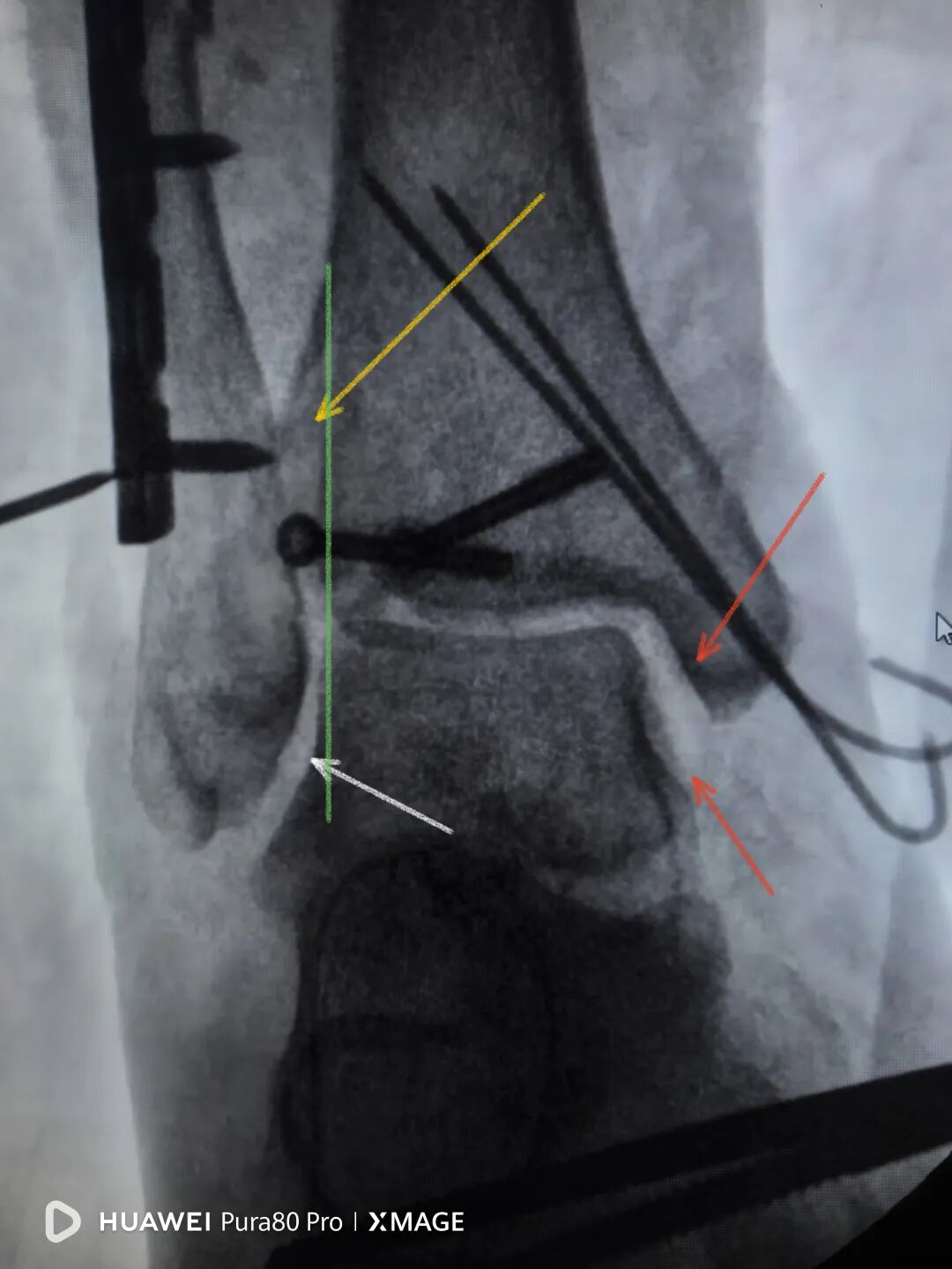怎么做开放踝关节骨折脱位，高清图解！