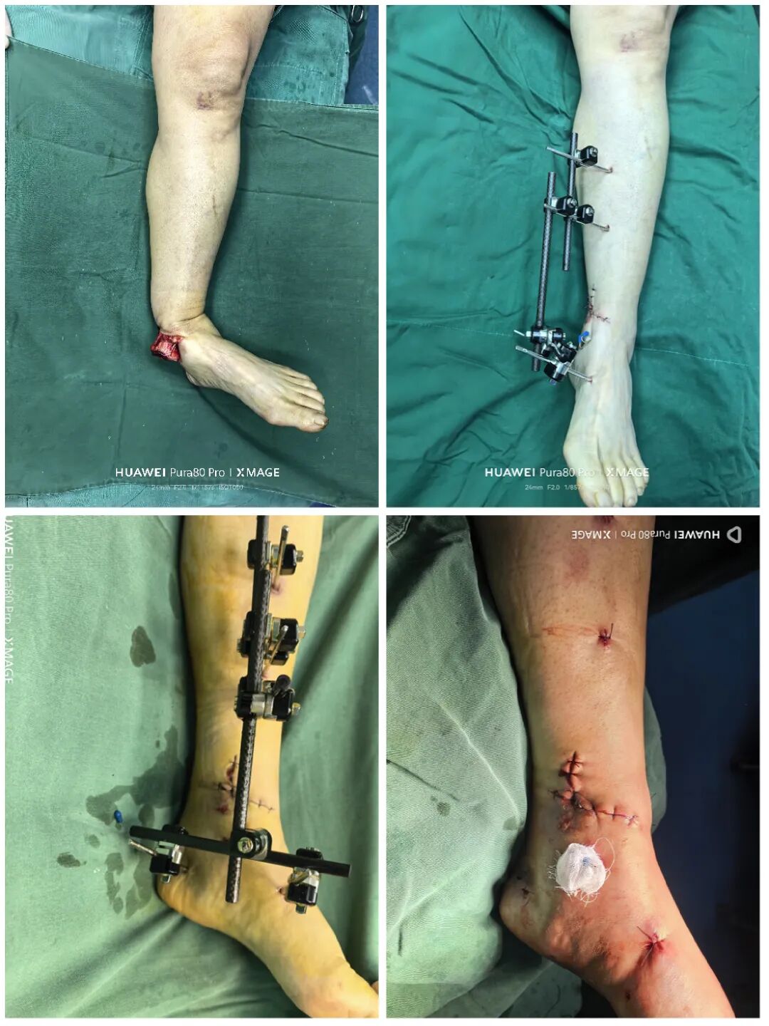 怎么做开放踝关节骨折脱位，高清图解！