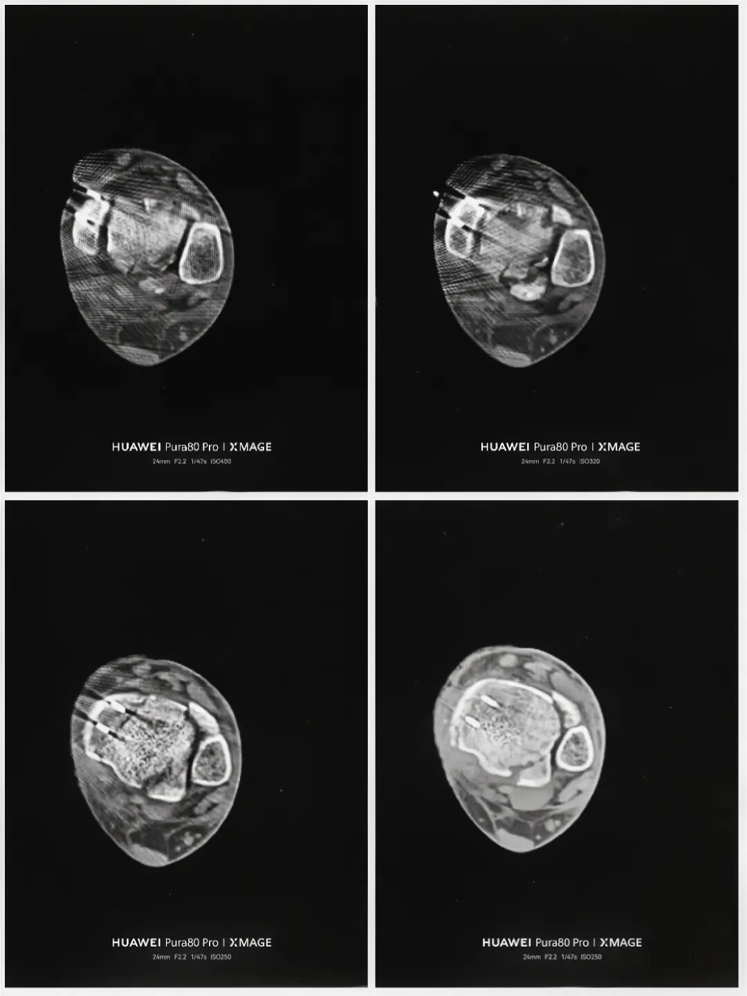 怎么做开放踝关节骨折脱位，高清图解！