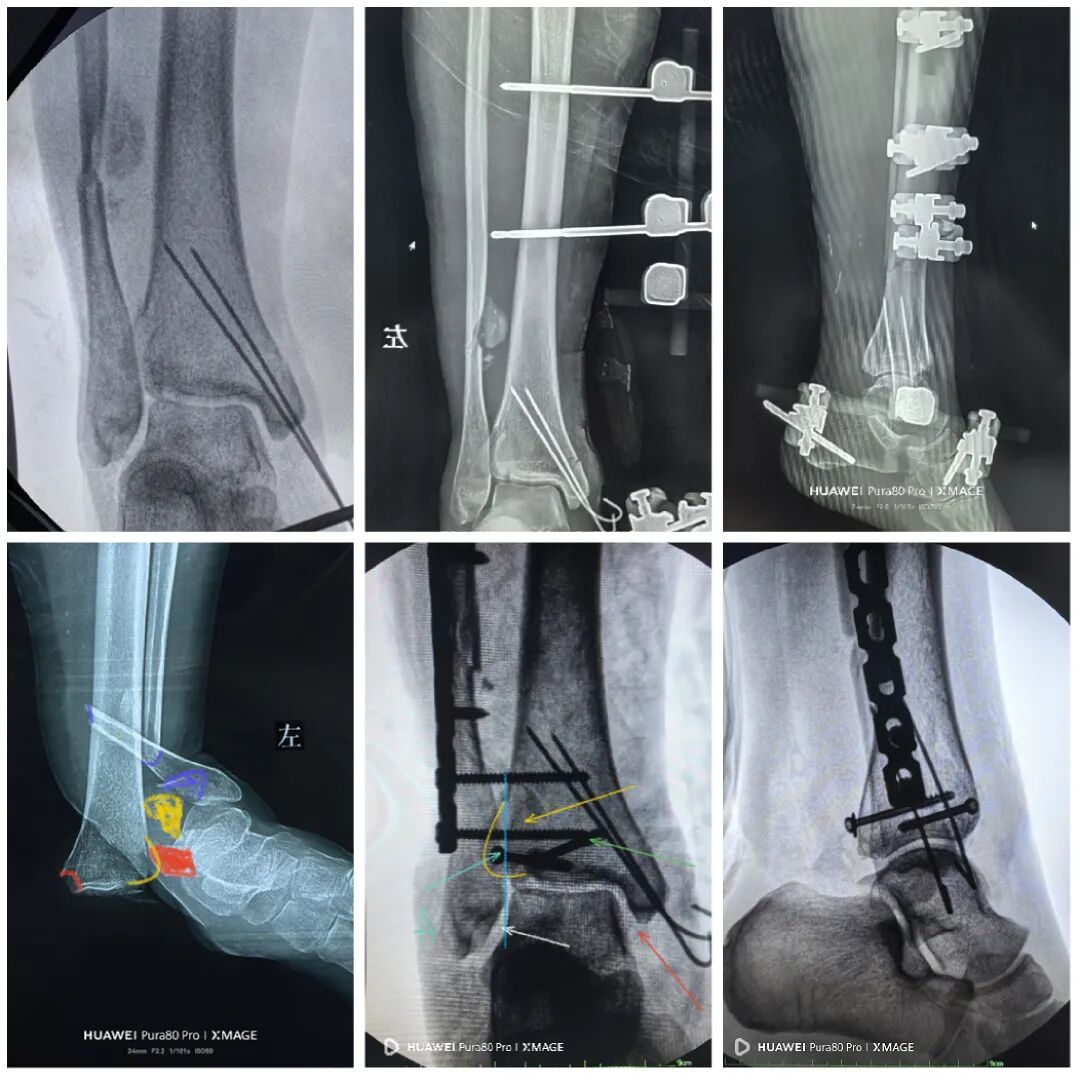 怎么做开放踝关节骨折脱位，高清图解！