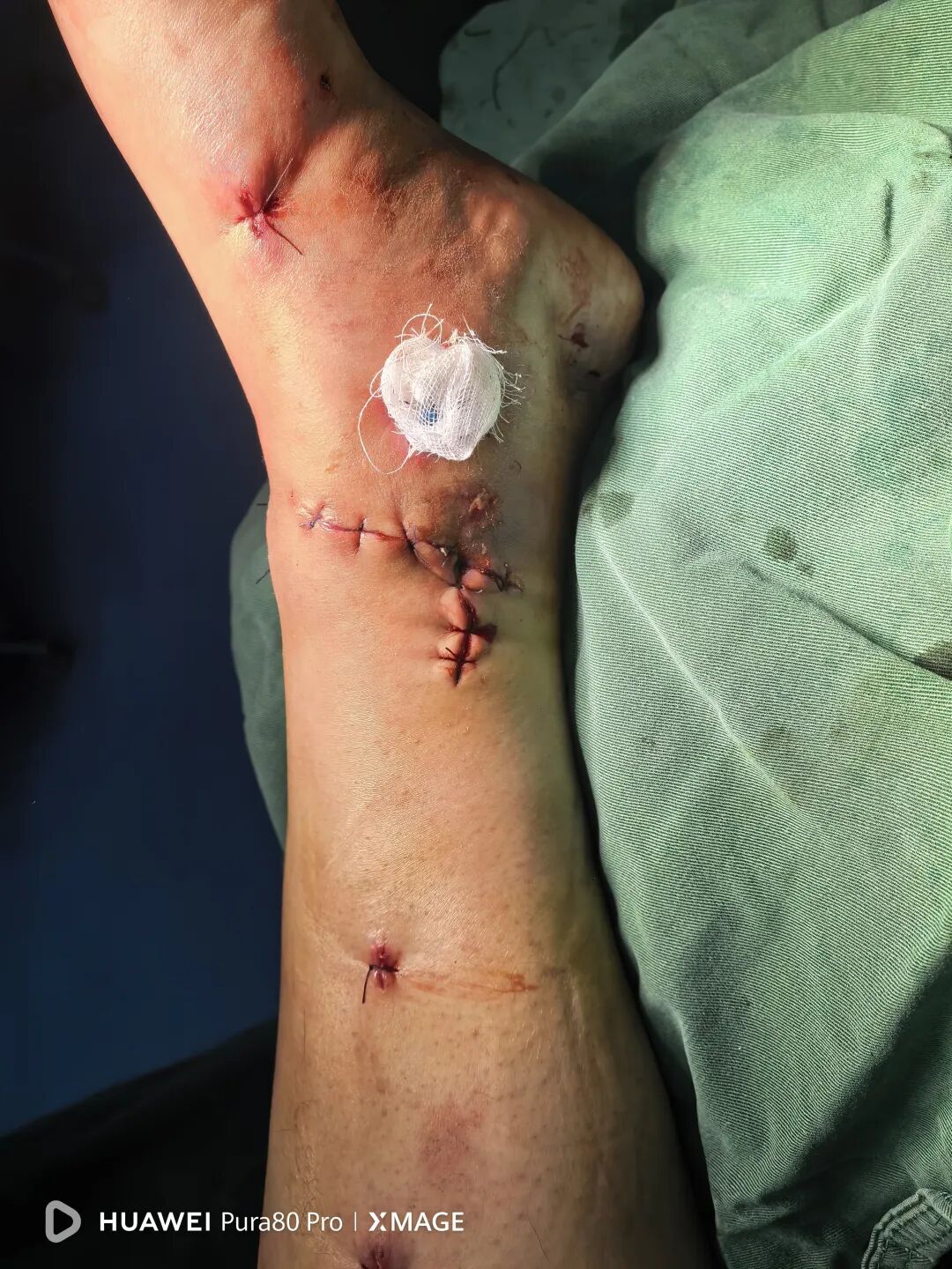 怎么做开放踝关节骨折脱位，高清图解！