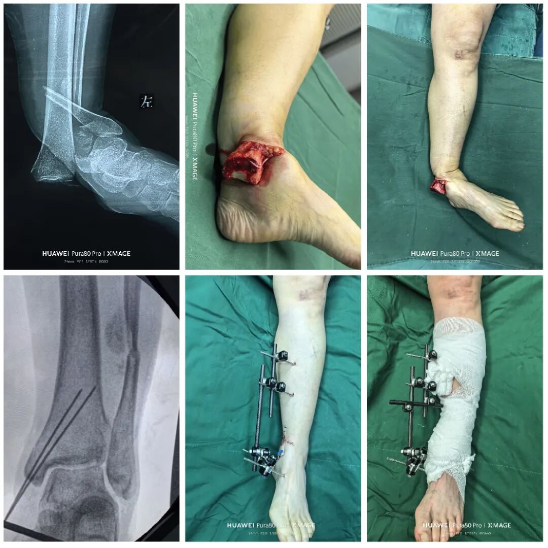 怎么做开放踝关节骨折脱位，高清图解！