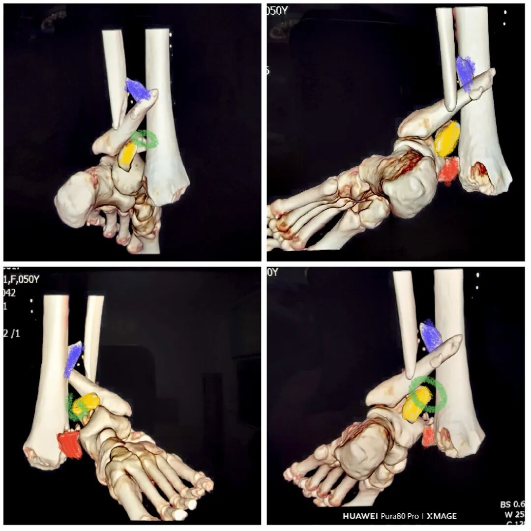 怎么做开放踝关节骨折脱位，高清图解！
