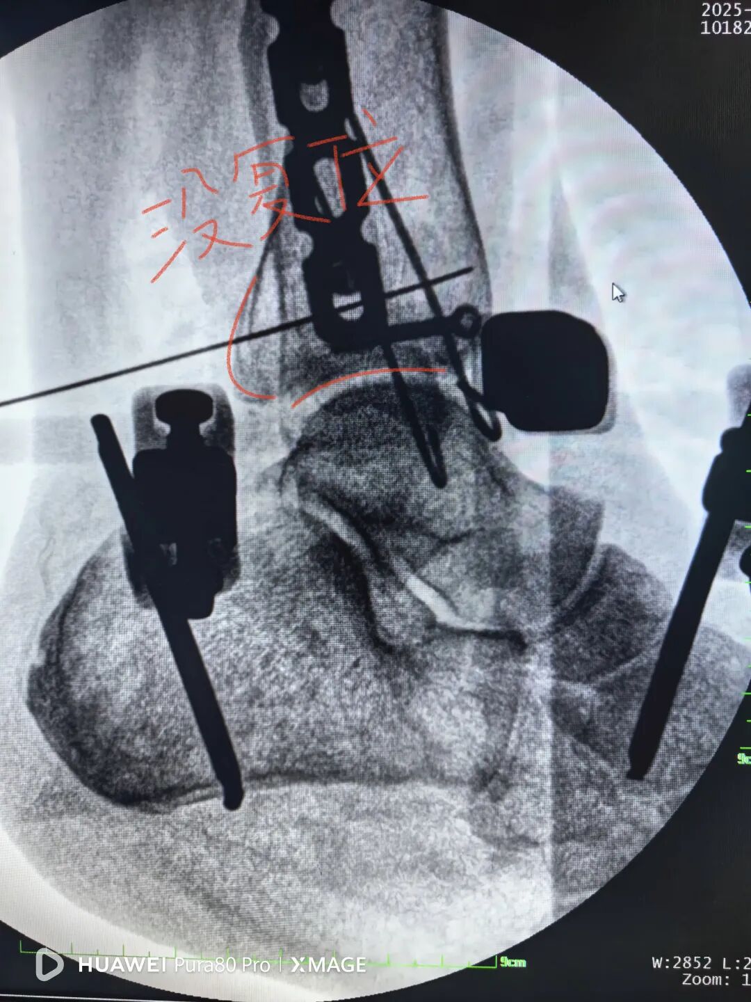 怎么做开放踝关节骨折脱位，高清图解！