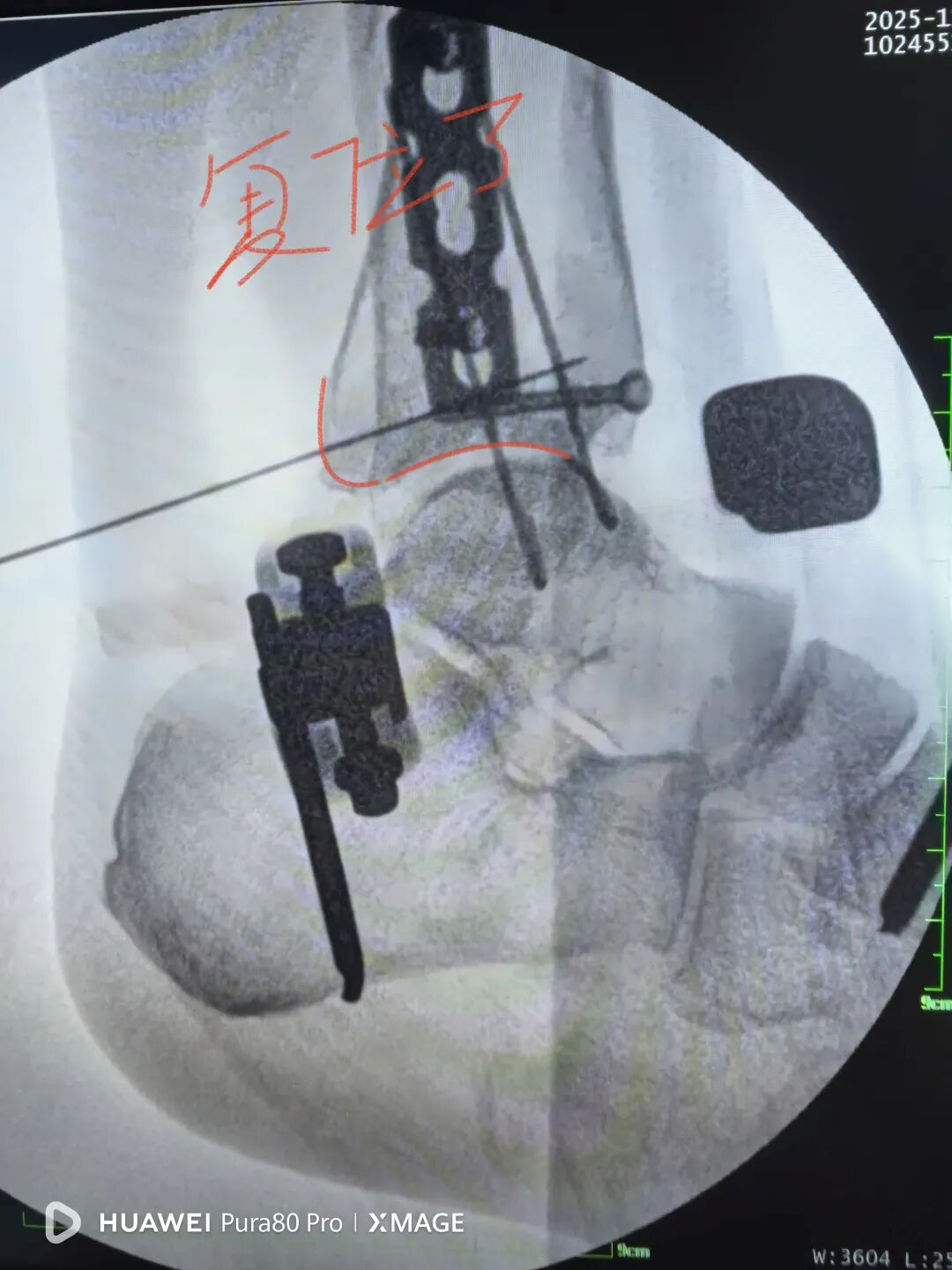 怎么做开放踝关节骨折脱位，高清图解！