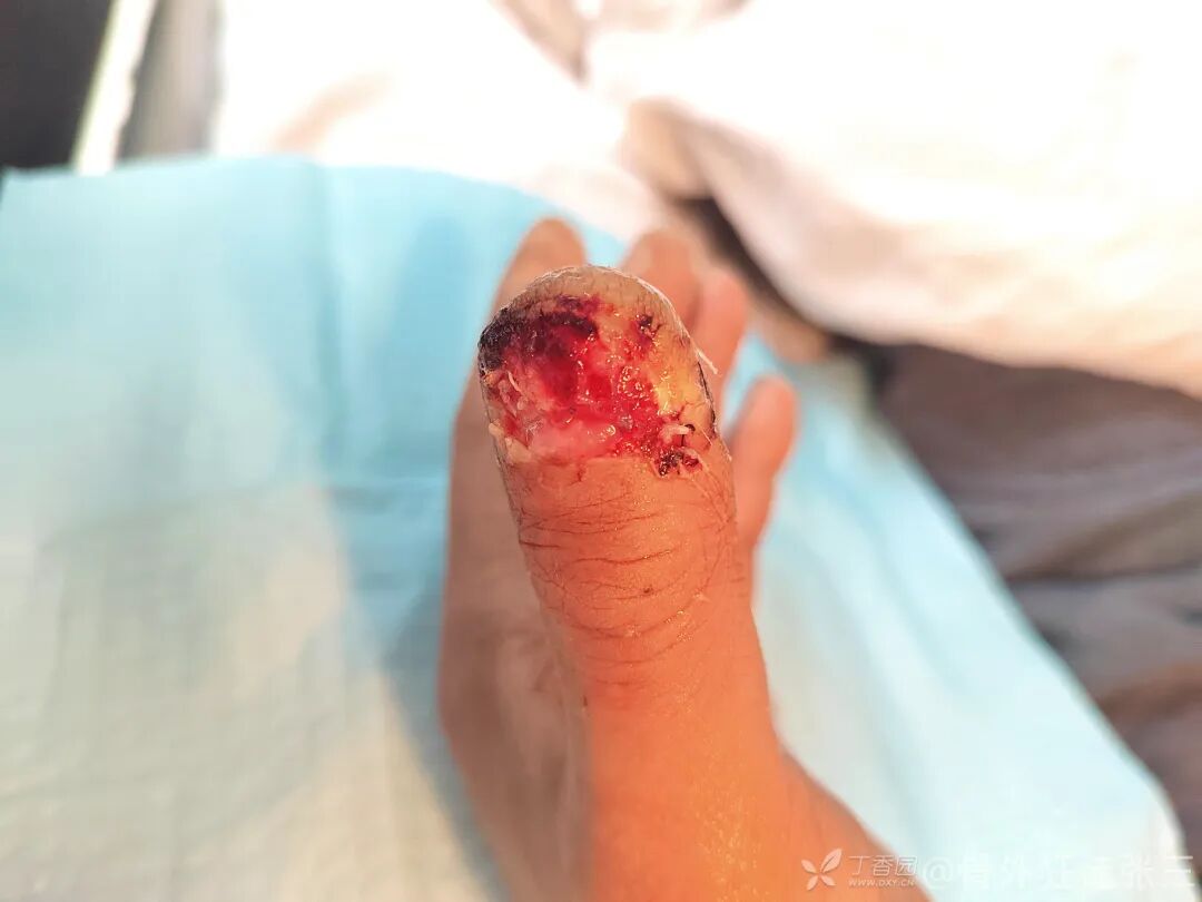 “精密对合，疏松缝合，”