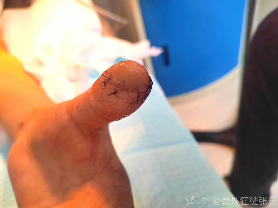 “精密对合，疏松缝合，”