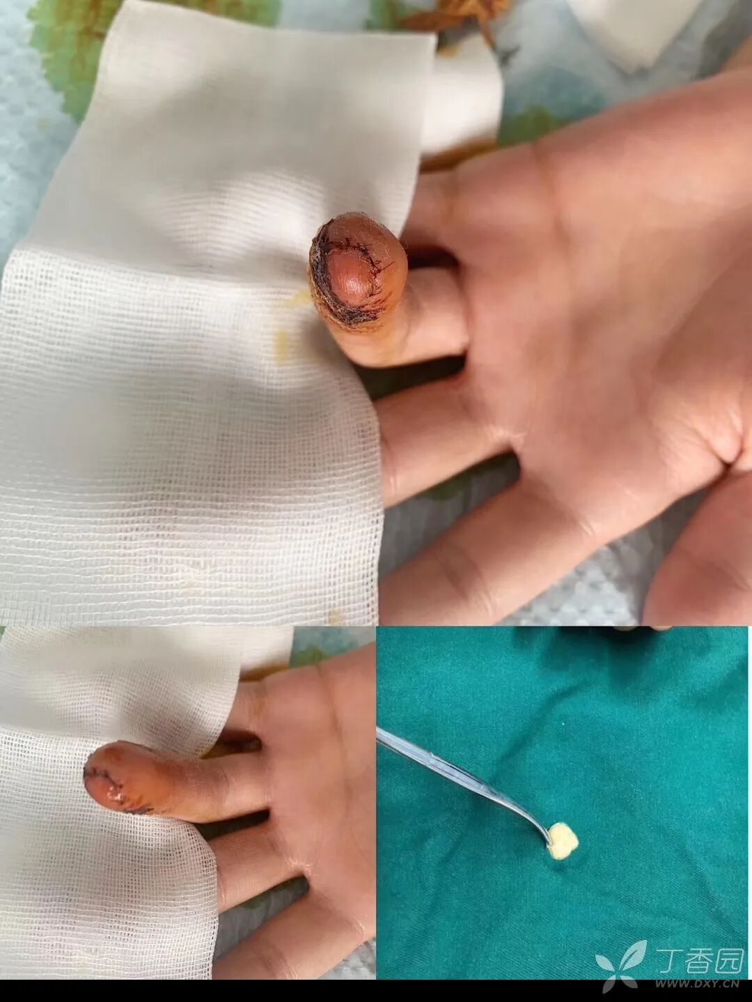 “精密对合，疏松缝合，”