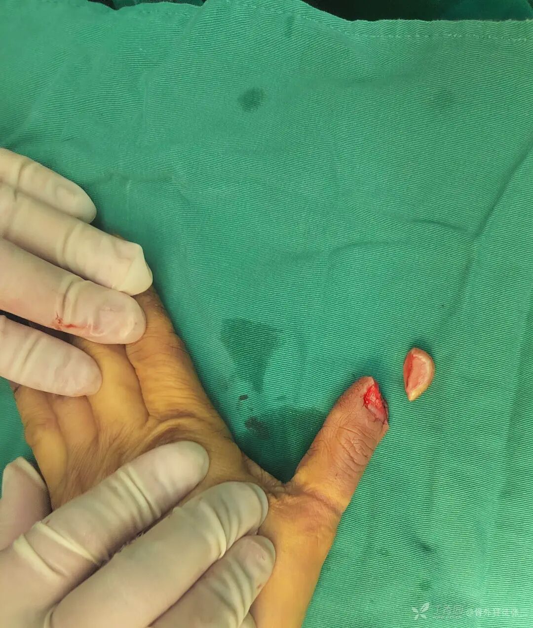 “精密对合，疏松缝合，”