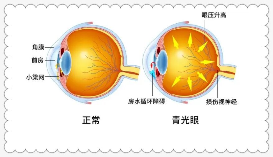 goldmann眼压计怎么读科普｜眼压测量的金标准是什么？_https://www.jmylbn.com_新闻资讯_第4张