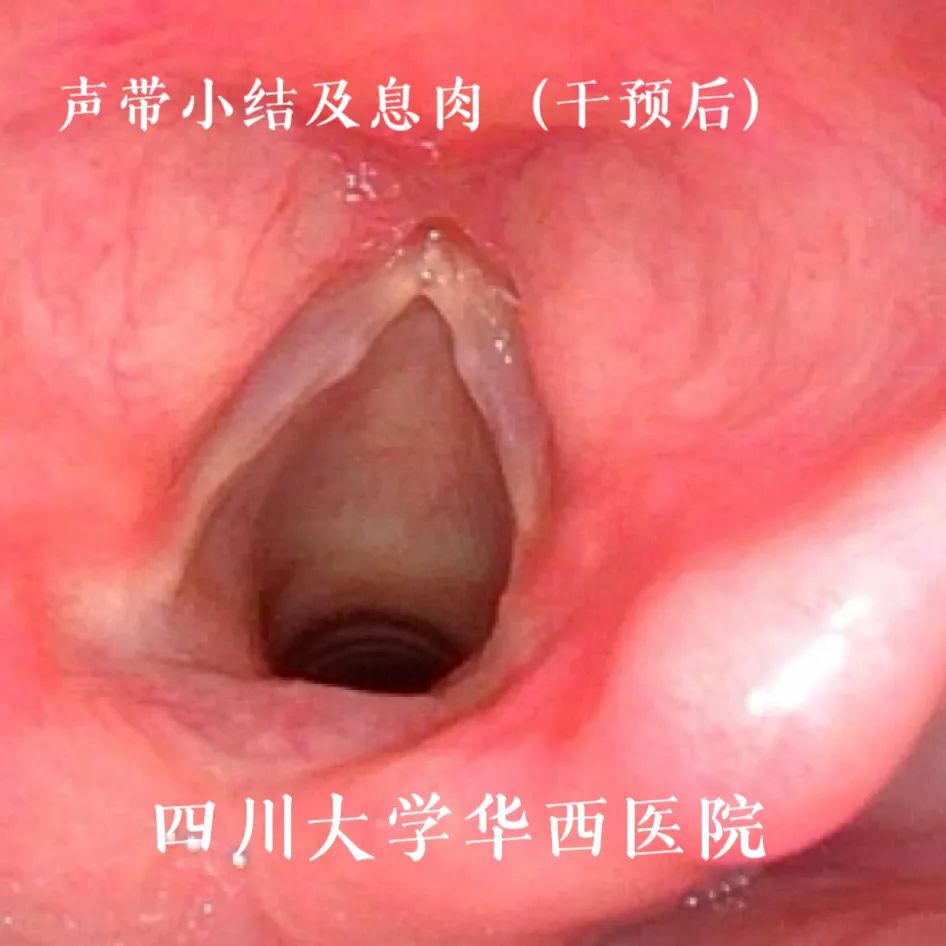 【世界嗓音日】悦耳嗓音从娃娃抓起