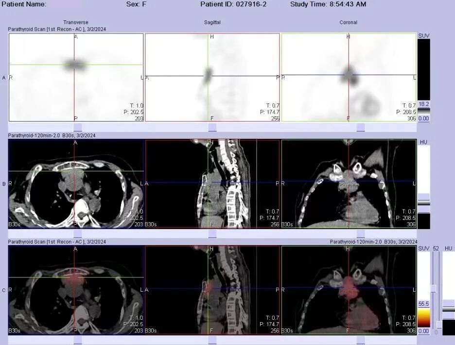 d-spect怎么检查【科普-健康知识】探寻角落里的“它”——SPECT／CT甲状旁腺显像_https://www.jmylbn.com_新闻资讯_第5张