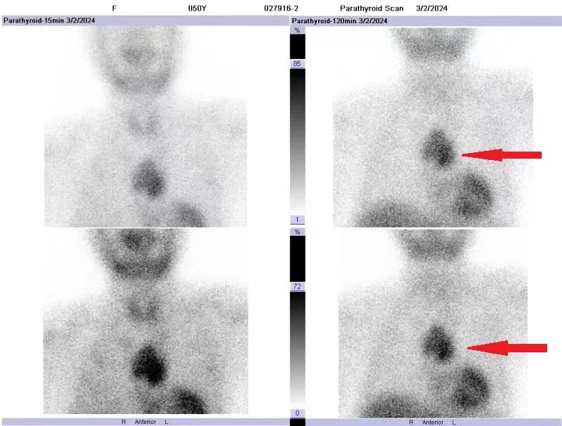 d-spect怎么检查【科普-健康知识】探寻角落里的“它”——SPECT／CT甲状旁腺显像_https://www.jmylbn.com_新闻资讯_第4张