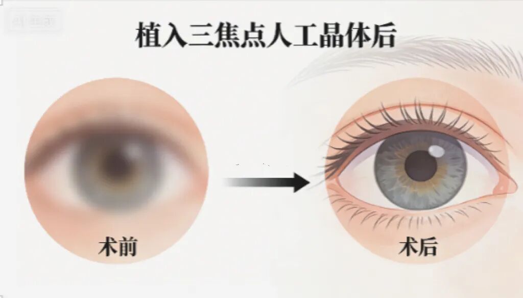 重获清晰“视”界 | 中山一院广西医院眼科成功为狼疮患者实施双眼三焦点人工晶体植入术