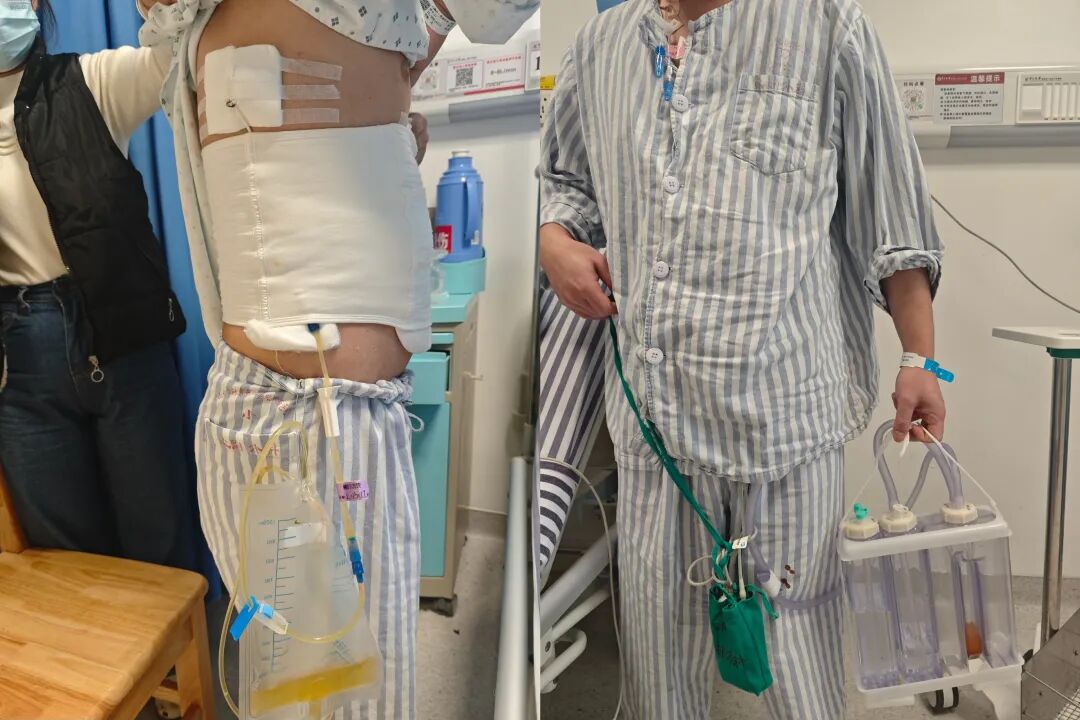 告别反复穿刺 | 中山一院广西医院胸腔积液诊疗让患者有了更省心的新选择