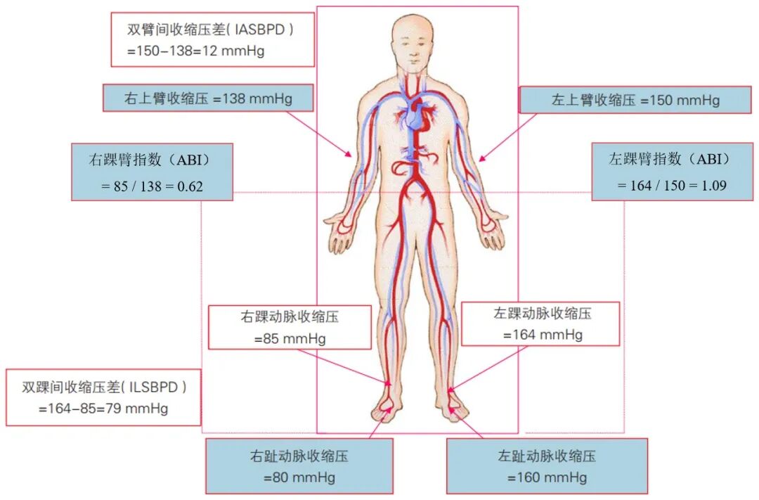 动脉硬化测什么【药说】四肢血压测量与动脉硬化病变_https://www.jmylbn.com_新闻资讯_第2张