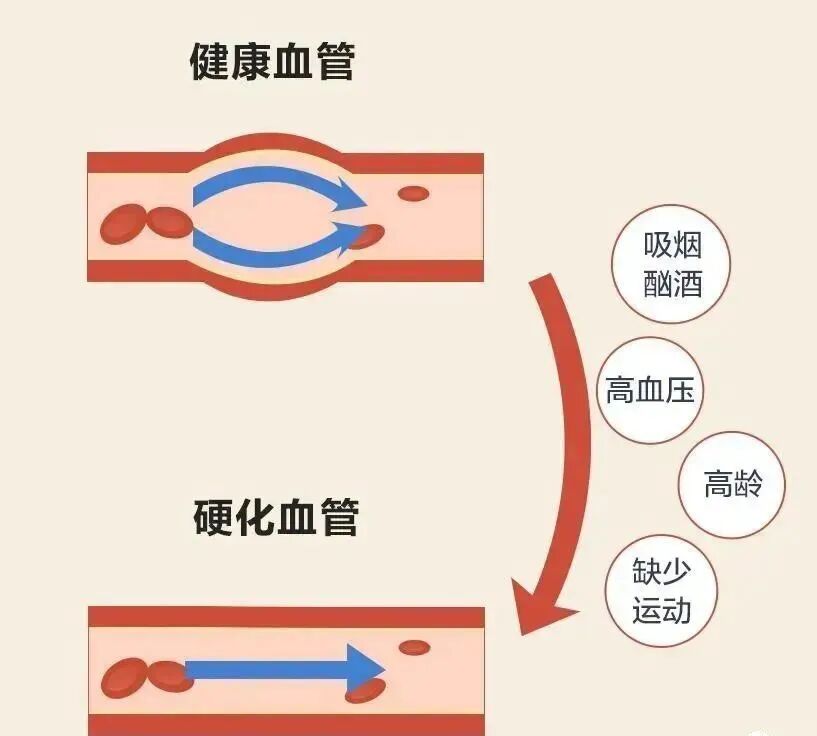 动脉硬化检测检查什么【科普】健康体检需要做动脉硬化检测吗？_https://www.jmylbn.com_新闻资讯_第16张