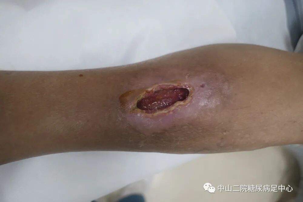 伤口负压治疗怎么收费54天，治愈一例小腿胫前溃疡的糖尿病病人！_https://www.jmylbn.com_新闻资讯_第8张