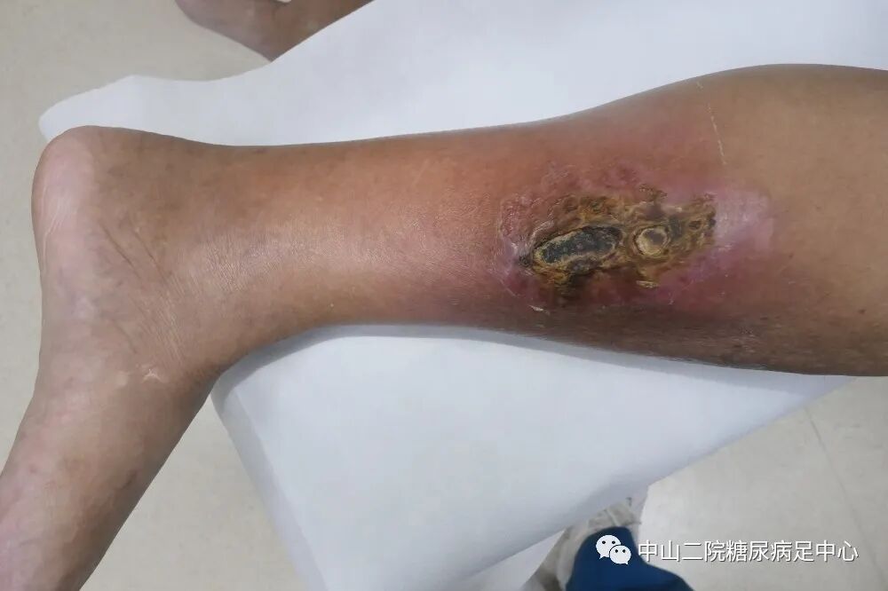 伤口负压治疗怎么收费54天，治愈一例小腿胫前溃疡的糖尿病病人！_https://www.jmylbn.com_新闻资讯_第1张