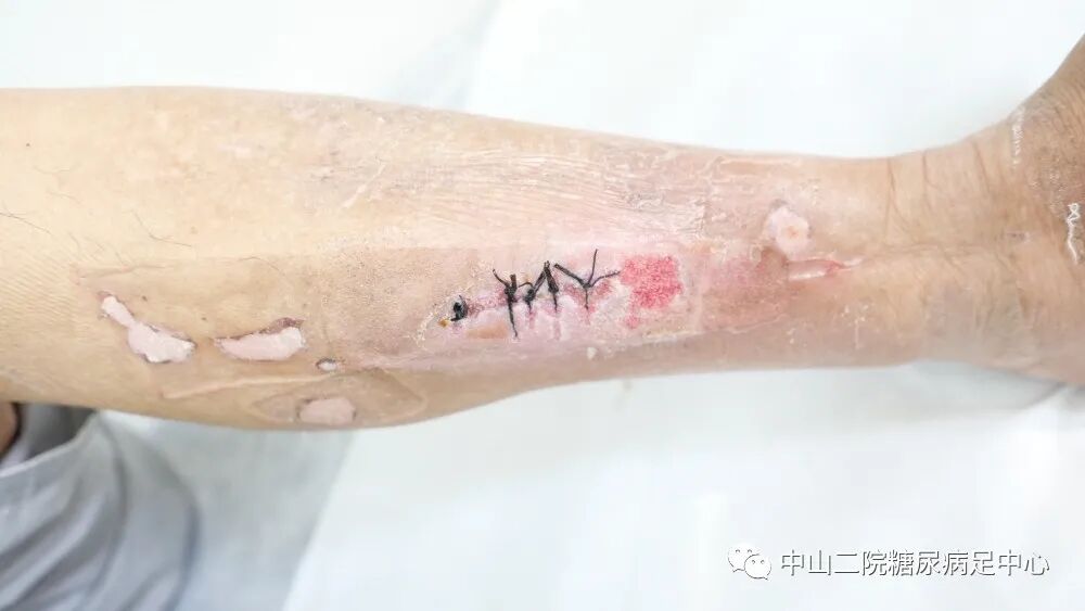 伤口负压治疗怎么收费54天，治愈一例小腿胫前溃疡的糖尿病病人！_https://www.jmylbn.com_新闻资讯_第14张