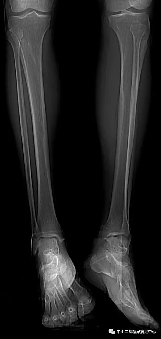 伤口负压治疗怎么收费54天，治愈一例小腿胫前溃疡的糖尿病病人！_https://www.jmylbn.com_新闻资讯_第3张