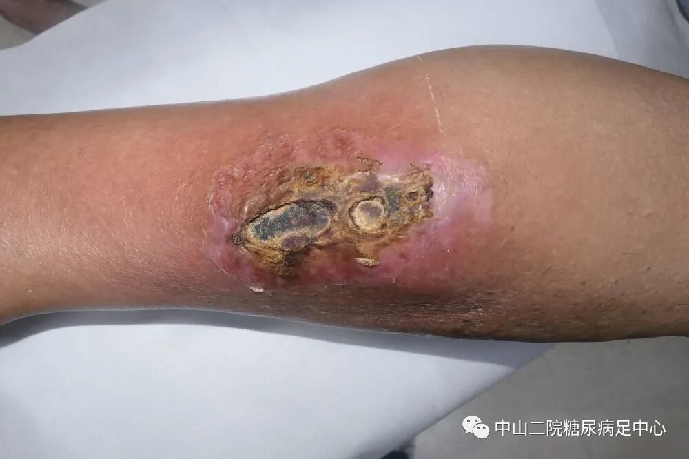 伤口负压治疗怎么收费54天，治愈一例小腿胫前溃疡的糖尿病病人！_https://www.jmylbn.com_新闻资讯_第2张