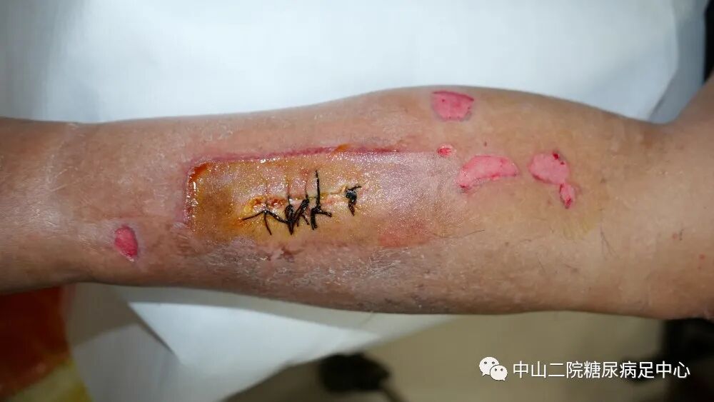 伤口负压治疗怎么收费54天，治愈一例小腿胫前溃疡的糖尿病病人！_https://www.jmylbn.com_新闻资讯_第12张