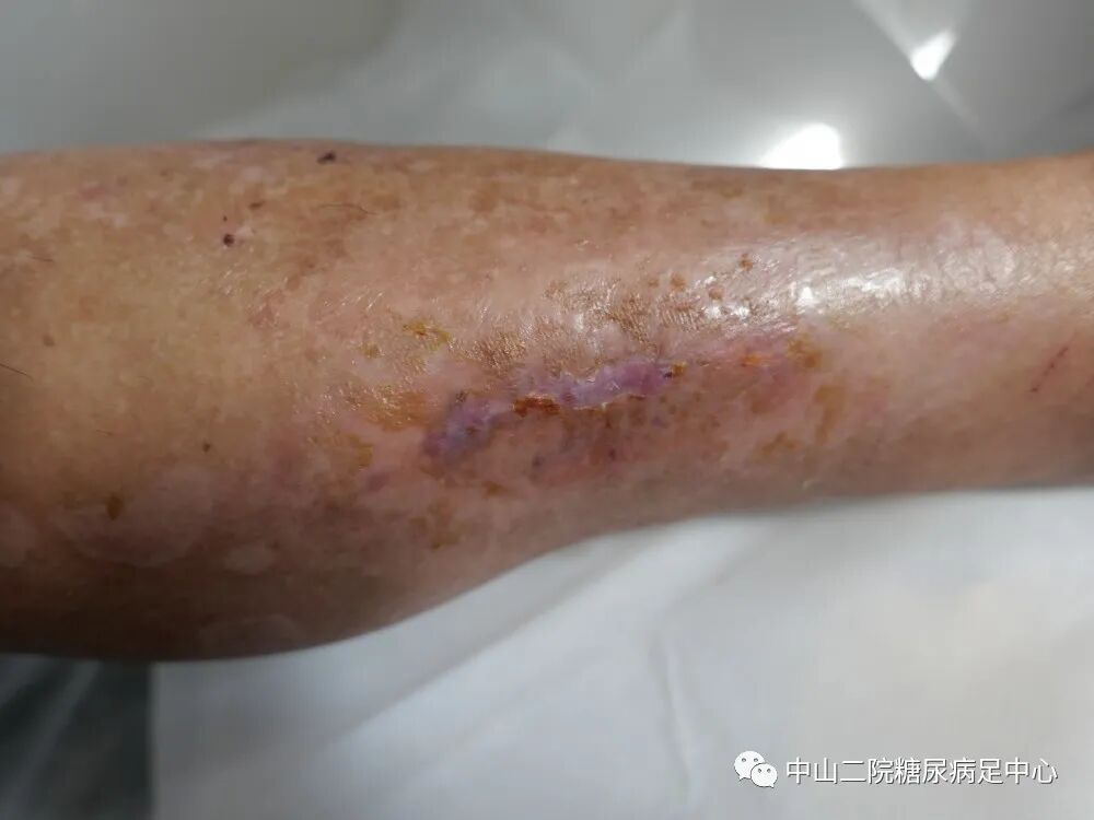 伤口负压治疗怎么收费54天，治愈一例小腿胫前溃疡的糖尿病病人！_https://www.jmylbn.com_新闻资讯_第19张