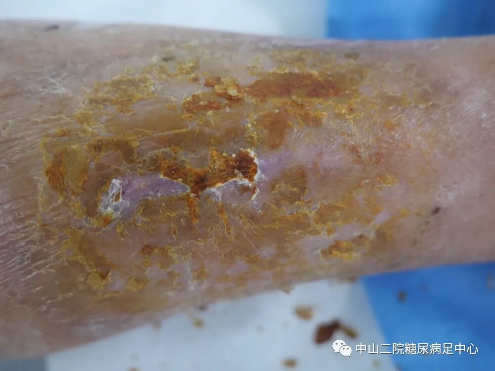 伤口负压治疗怎么收费54天，治愈一例小腿胫前溃疡的糖尿病病人！_https://www.jmylbn.com_新闻资讯_第18张
