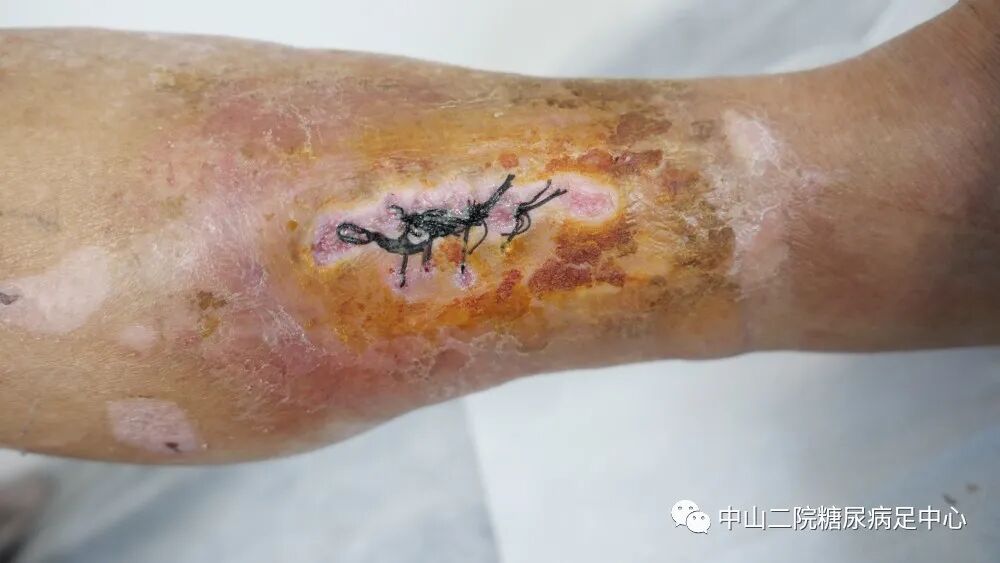 伤口负压治疗怎么收费54天，治愈一例小腿胫前溃疡的糖尿病病人！_https://www.jmylbn.com_新闻资讯_第15张